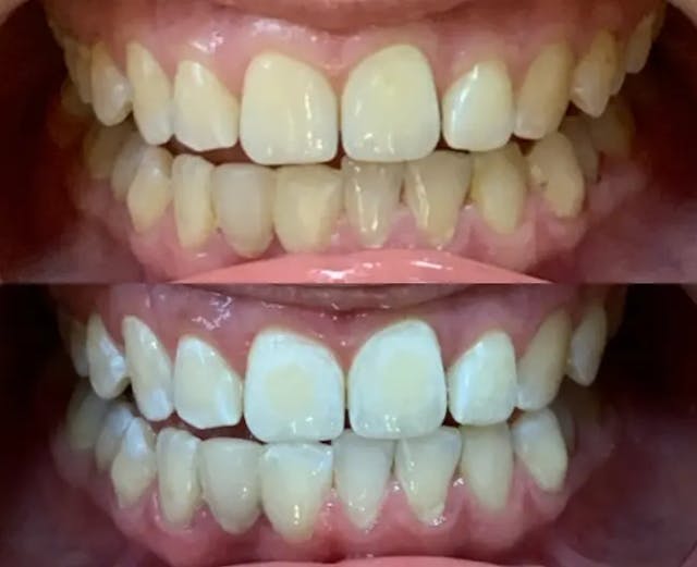 Зуби до і після відбілювання