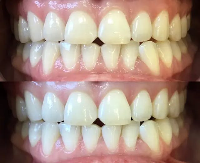 Зуби до і після відбілювання